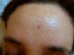 Angioma