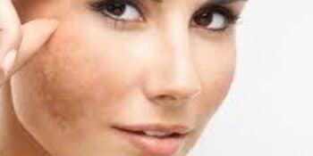 Melasma y sol: ¿buena combinación?