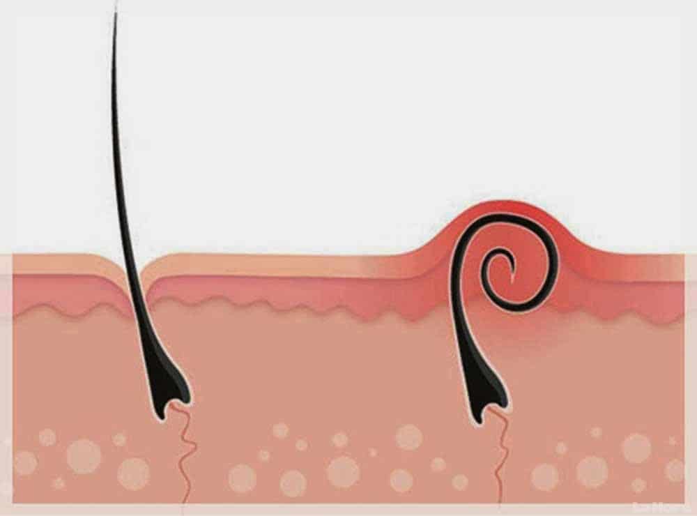 Foliculitis